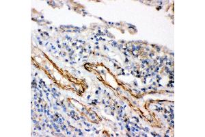 Anti- IKK beta antibody,IHC(P) IHC(P): Human Lung Cancer Tissue (IKBKB antibody  (AA 398-756))