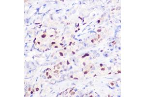 Immunohistochemistry of paraffin-embedded human breast cancer using [KO Validated] CDKN1A/p21CIP1 Rabbit pAb (ABIN1679159, ABIN1679158, ABIN3016472 and ABIN6219758) at dilution of 1:100 (40x lens). (p21 antibody  (AA 1-164))