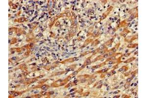 Immunohistochemistry of paraffin-embedded human liver cancer using ABIN7156663 at dilution of 1:100 (IFIT1 antibody  (AA 1-181))