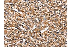 The image on the left is immunohistochemistry of paraffin-embedded Human prostate cancer tissue using ABIN7192449(SLC26A5 Antibody) at dilution 1/20, on the right is treated with synthetic peptide. (SLC26A5 antibody)