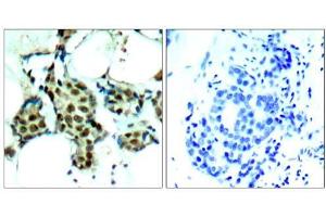 Immunohistochemical analysis of paraffin-embedded human breast carcinoma tissue, using P38 MAPK (phospho- Tyr182) antibody (E011253). (MAPK14 antibody  (pTyr182))