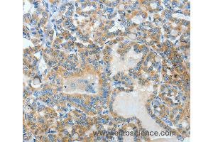 Immunohistochemistry of Human thyroid cancer using BAAT Polyclonal Antibody at dilution of 1:30 (BAAT antibody)