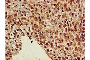Immunohistochemistry of paraffin-embedded human glioma using ABIN7161911 at dilution of 1:100 (NR5A2 + LRH1 antibody  (AA 182-291))