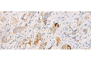Immunohistochemistry of paraffin-embedded Human liver cancer tissue using DHRS2 Polyclonal Antibody at dilution of 1:50(x200) (DHRS2 antibody)