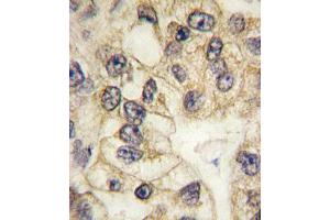 Formalin-fixed and paraffin-embedded human lung carcinoma tissue reacted with CD14 antibody (C-term) (ABIN390261 and ABIN2840719) , which was peroxidase-conjugated to the secondary antibody, followed by DAB staining. (CD14 antibody  (C-Term))