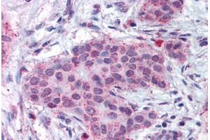 Human Breast Carcinoma (formalin-fixed, paraffin-embedded) stained with MMP13 antibody ABIN301763 at 17 ug/ml followed by biotinylated goat anti-rabbit IgG secondary antibody ABIN481713, alkaline phosphatase-streptavidin and chromogen. (MMP13 antibody  (N-Term))