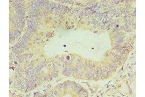 Immunohistochemistry of paraffin-embedded human colon cancer using ABIN7150731 at dilution of 1:100 (CLK2 antibody  (AA 240-499))