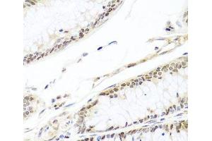 Immunohistochemistry of paraffin-embedded Human colon carcinoma using HIRA Polyclonal Antibody at dilution of 1:100 (40x lens). (HIRA antibody)
