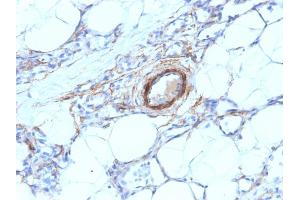 Formalin-fixed, paraffin-embedded human Angiosarcoma stained with SM-MHC Mouse Monoclonal Antibody (MYH11/923). (MYH11 antibody)