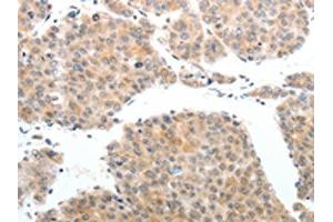The image on the left is immunohistochemistry of paraffin-embedded Human liver cancer tissue using ABIN7189608(ABL2 Antibody) at dilution 1/25, on the right is treated with synthetic peptide. (ABL2 antibody)
