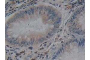 Detection of ACE in Human Colorectal cancer Tissue using Polyclonal Antibody to Angiotensin I Converting Enzyme (ACE) (Angiotensin I Converting Enzyme 1 antibody  (AA 1160-1306))
