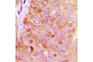 Immunohistochemical analysis of FAM203A staining in human breast cancer formalin fixed paraffin embedded tissue section. (FAM203B antibody)