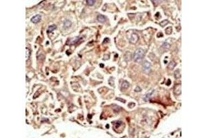 IHC analysis of FFPE human hepatocarcinoma tissue stained with the ALK2 antibody (ACVR1 antibody  (AA 132-162))