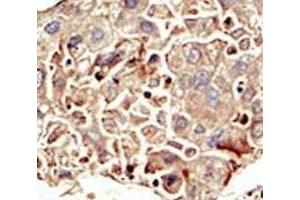 IHC analysis of FFPE human hepatocarcinoma tissue stained with the ALK2 antibody
