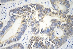 Immunohistochemistry was performed on paraffin-embedded human sigmoid colon carcinoma using catenin beta 1 antibody (ABIN7797927), 1:200). (CTNNB1 antibody)