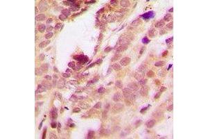 Immunohistochemical analysis of p38 (pT180/Y182) staining in human breast cancer formalin fixed paraffin embedded tissue section. (MAPK14 antibody  (pThr180, pTyr182))