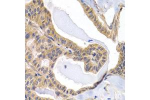 Immunohistochemistry of paraffin-embedded human thyroid cancer using PTGIR antibody at dilution of 1:200 (400x lens).