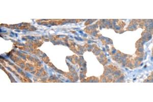 Immunohistochemistry of paraffin-embedded Human thyroid cancer tissue using RTN4IP1 Polyclonal Antibody at dilution of 1:50(x200)