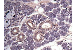 IHC-P Image Immunohistochemical analysis of human salivary gland cancer, using MMP3, antibody at 1:100 dilution. (MMP3 antibody  (N-Term))