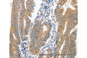 Immunohistochemistry of Human colon cancer using CENPC Polyclonal Antibody at dilution of 1:70
