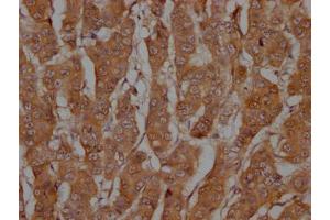 IHC image of ABIN7127776 diluted at 1:100 and staining in paraffin-embedded human breast cancer performed on a Leica BondTM system. (Recombinant Caspase 3 antibody)