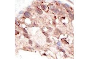 Formalin-fixed and paraffin-embedded human cancer tissue reacted with the primary antibody, which was peroxidase-conjugated to the secondary antibody, followed by DAB staining. (SUV39H2 antibody  (C-Term))