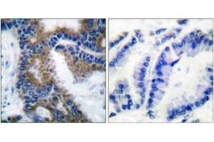 Immunohistochemistry analysis of paraffin-embedded human lung carcinoma, using CrkL (Phospho-Tyr207) Antibody. (CrkL antibody  (pTyr207))