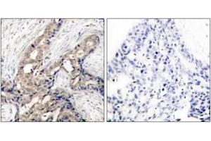 Immunohistochemistry analysis of paraffin-embedded human breast carcinoma, using Abl (Phospho-Tyr393/412) Antibody. (ABL1 antibody  (pTyr393))