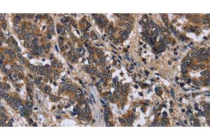 Immunohistochemistry of paraffin-embedded Human liver cancer using FRK Polyclonal Antibody at dilution of 1:50 (FRK antibody)
