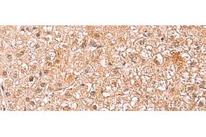 Immunohistochemistry of paraffin-embedded Human liver cancer tissue using ASTN2 Polyclonal Antibody at dilution of 1:80(x200)