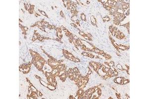 IHC analysis of Cytokeratin 19 using anti-Cytokeratin 19 antibody (ABIN3043288). (Cytokeratin 19 antibody  (C-Term))