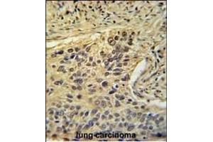 TAF2 Antibody (C-Term) (ABIN653923 and ABIN2843157) immunohistochemistry analysis in formalin fixed and paraffin embedded human lung carcinoma followed by peroxidase conjugation of the secondary antibody and DAB staining. (TAF2 antibody  (C-Term))