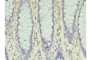 Immunohistochemistry of paraffin-embedded human colon cancer using ABIN7170235 at dilution of 1:100