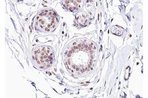 ABIN6267276 at 1/100 staining human Breast carcinoma tissue sections by IHC-P. (Estrogen Receptor alpha antibody  (pSer104))