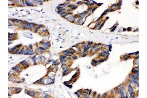 Anti- DLD Picoband antibody, IHC(P) IHC(P): Human Intestinal Cancer Tissue (DLD antibody  (AA 300-509))