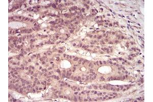 Immunohistochemical analysis of paraffin-embedded colon cancer tissues using PKN1 mouse mAb with DAB staining. (PKN1 antibody  (AA 442-620))