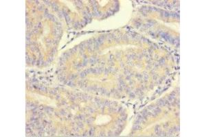 Immunohistochemistry of paraffin-embedded human endometrial cancer using ABIN7165325 at dilution of 1:100 (LMAN1L antibody  (AA 26-462))