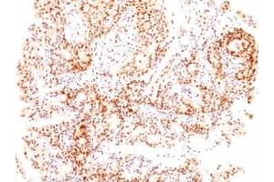 Formalin-fixed, paraffin-embedded human ovarian carcinoma stained with Estrogen Receptor beta antibody (ESR2/686).