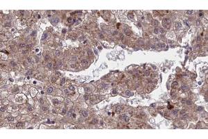 ABIN6273970 at 1/100 staining Human liver cancer tissue by IHC-P. (OR1J4 antibody  (C-Term))