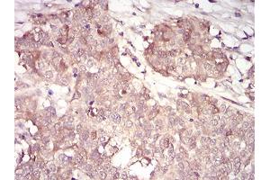Immunohistochemical analysis of paraffin-embedded bladder cancer tissues using CCNA2 mouse mAb with DAB staining. (Cyclin A antibody  (AA 105-233))