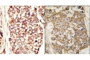 (LEFT)Formalin-fixed and paraffin-embedded human cancer tissue reacted with the primary antibody, which was peroxidase-conjugated to the secondary antibody, followed by AEC staining. (ErbB2/Her2 antibody  (N-Term))