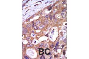 Formalin-fixed and paraffin-embedded human cancer tissue reacted with PRKD1 polyclonal antibody  , which was peroxidase-conjugated to the secondary antibody, followed by AEC staining . (PKC mu antibody  (N-Term))