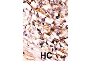 Formalin-fixed and paraffin-embedded human cancer tissue reacted with the primary antibody, which was peroxidase-conjugated to the secondary antibody, followed by DAB staining. (MAPKAP Kinase 5 antibody  (pSer93))