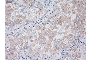 Immunohistochemical staining of paraffin-embedded Carcinoma of kidney tissue using anti-KRT19mouse monoclonal antibody. (Cytokeratin 19 antibody  (AA 240-390))