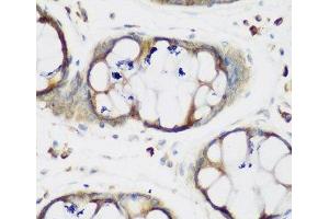 Immunohistochemistry of paraffin-embedded Human gastric using MTDH Polyclonal Antibody at dilution of 1:200 (40x lens). (MTDH antibody)