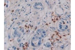 Detection of IL6 in Human Breast cancer Tissue using Monoclonal Antibody to Interleukin 6 (IL6) (IL-6 antibody  (AA 27-212))