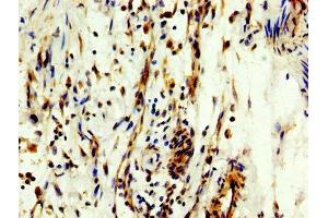 IHC image of ABIN7160441 diluted at 1:300 and staining in paraffin-embedded human bladder cancer performed on a Leica BondTM system. (MYT1 antibody  (AA 317-451))