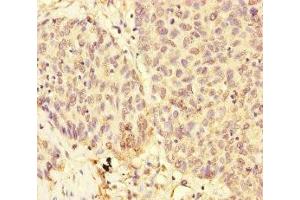 Immunohistochemistry of paraffin-embedded human ovarian cancer using ABIN7174302 at dilution of 1:100 (USP28 antibody  (AA 430-580))