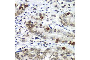 Immunohistochemistry of paraffin-embedded human gastric cancer using DR1 antibody at dilution of 1:100 (x40 lens). (DR1 antibody)