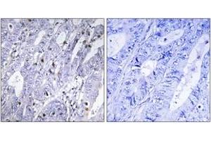 Immunohistochemistry analysis of paraffin-embedded human colon carcinoma tissue, using MEF2D (Ab-444) Antibody. (MEF2D antibody  (AA 410-459))